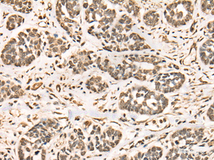 Immunohistochemistry of paraffin-embedded Human esophagus cancer tissue using BRD7 Polyclonal Antibody at dilution of 1:50 (×200)