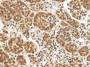 Immunohistochemistry of paraffin-embedded Human esophagus cancer tissue using BRSK1 Polyclonal Antibody at dilution of 1:95 (×200)