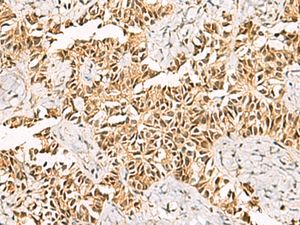 Immunohistochemistry of paraffin-embedded Human ovarian cancer tissue using LRIF1 Polyclonal Antibody at dilution of 1:70 (×200)