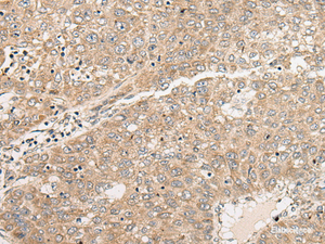 Immunohistochemistry of paraffin-embedded Human liver cancer tissue using C1orf101 Polyclonal Antibody at dilution of 1:45 (×200)