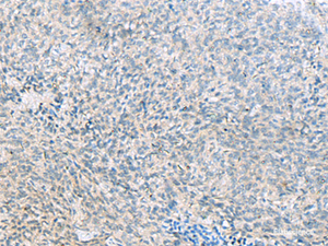 Immunohistochemistry of paraffin-embedded Human cervical cancer tissue using C1orf112 Polyclonal Antibody at dilution of 1:55 (×200)