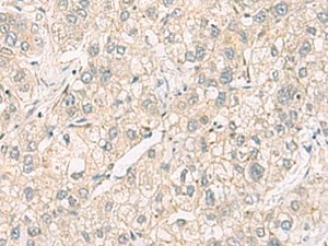 Immunohistochemistry of paraffin-embedded Human liver cancer tissue using C3orf38 Polyclonal Antibody at dilution of 1:95 (×200)
