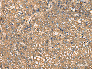 Immunohistochemistry of paraffin-embedded Human liver cancer tissue using C4BPB Polyclonal Antibody at dilution of 1:35 (×200)