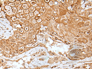 Immunohistochemistry of paraffin-embedded Human esophagus cancer tissue using IL6ST Polyclonal Antibody at dilution of 1:40 (×200)