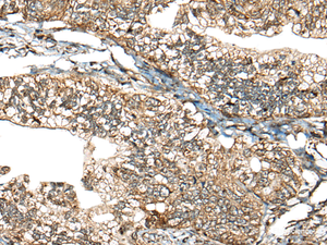 Immunohistochemistry of paraffin-embedded Human gastric cancer tissue using CALHM1 Polyclonal Antibody at dilution of 1:40 (×200)
