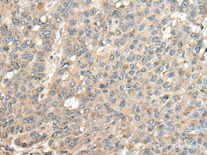 Immunohistochemistry of paraffin-embedded Human liver cancer tissue using CASQ1 Polyclonal Antibody at dilution of 1:100 (×200)