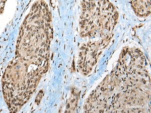 Immunohistochemistry of paraffin-embedded Human esophagus cancer tissue using CCDC12 Polyclonal Antibody at dilution of 1:50 (×200)