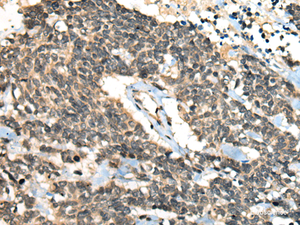 Immunohistochemistry of paraffin-embedded Human lung cancer tissue using CCNB1IP1 Polyclonal Antibody at dilution of 1:30 (×200)