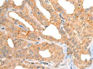 Immunohistochemistry of paraffin-embedded Human thyroid cancer tissue using CECR1 Polyclonal Antibody at dilution of 1:40 (×200)