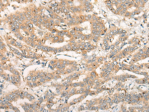 Immunohistochemistry of paraffin-embedded Human liver cancer tissue using CPNE4 Polyclonal Antibody at dilution of 1:40 (×200)