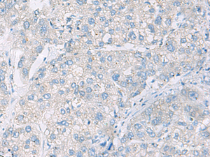 Immunohistochemistry of paraffin-embedded Human liver cancer tissue using DACT3 Polyclonal Antibody at dilution of 1:55 (×200)