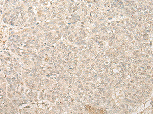 Immunohistochemistry of paraffin-embedded Human ovarian cancer tissue using FYTTD1 Polyclonal Antibody at dilution of 1:25 (×200)