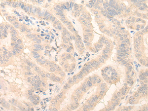 Immunohistochemistry of paraffin-embedded Human thyroid cancer tissue using HMBS Polyclonal Antibody at dilution of 1:25 (×200)