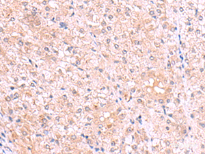 Immunohistochemistry of paraffin-embedded Human liver cancer tissue using PISD Polyclonal Antibody at dilution of 1:80 (×200)