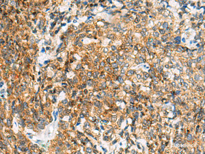 Immunohistochemistry of paraffin-embedded Human cervical cancer tissue using TUFT1 Polyclonal Antibody at dilution of 1:120 (×200)