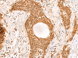 Immunohistochemistry of paraffin-embedded Human esophagus cancer tissue using RMND5B Polyclonal Antibody at dilution of 1:50 (×200)
