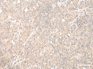 Immunohistochemistry of paraffin-embedded Human ovarian cancer tissue using HENMT1 Polyclonal Antibody at dilution of 1:35 (×200)