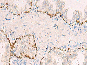 Immunohistochemistry of paraffin-embedded Human prost at e cancer tissue using TP63 Polyclonal Antibody at dilution of 1:40 (×200)