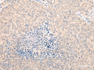 Immunohistochemistry of paraffin-embedded Human cervical cancer tissue using SEPT10 Polyclonal Antibody at dilution of 1:25 (×200)