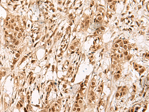 Immunohistochemistry of paraffin-embedded Human breast cancer tissue using ZBTB43 Polyclonal Antibody at dilution of 1:90 (×200)