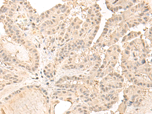 Immunohistochemistry of paraffin-embedded Human thyroid cancer tissue using ZGPAT Polyclonal Antibody at dilution of 1:35 (×200)