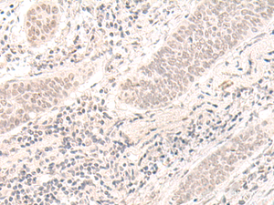 Immunohistochemistry of paraffin-embedded Human esophagus cancer tissue using ZBED1 Polyclonal Antibody at dilution of 1:40 (×200)