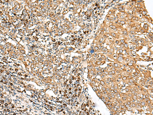 Immunohistochemistry of paraffin-embedded Human cervical cancer tissue using STT3A Polyclonal Antibody at dilution of 1:70 (×200)