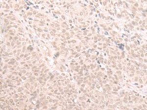 Immunohistochemistry of paraffin-embedded Human ovarian cancer tissue using HOOK2 Polyclonal Antibody at dilution of 1:30 (×200)