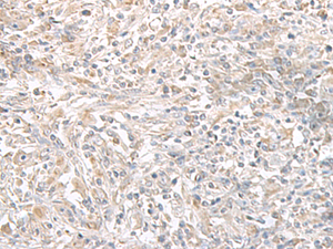 Immunohistochemistry of paraffin-embedded Human liver cancer tissue using PFKM Polyclonal Antibody at dilution of 1:50 (×200)