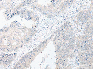 Immunohistochemistry of paraffin-embedded Human colorectal cancer tissue using GPRASP2 Polyclonal Antibody at dilution of 1:75 (×200)