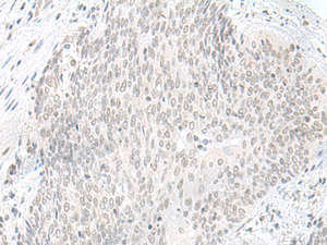 Immunohistochemistry of paraffin-embedded Human esophagus cancer tissue using ORC1 Polyclonal Antibody at dilution of 1:65 (×200)