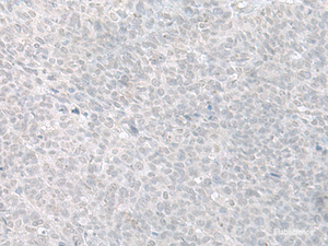 Immunohistochemistry of paraffin-embedded Human ovarian cancer tissue using C8orf4 Polyclonal Antibody at dilution of 1:70 (×200)