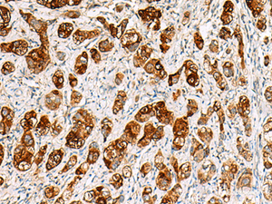 Immunohistochemistry of paraffin-embedded Human liver cancer tissue using SAA1 Polyclonal Antibody at dilution of 1:70 (×200)