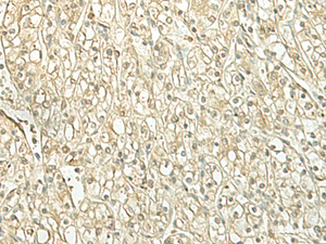 Immunohistochemistry of paraffin-embedded Human kidney cancer tissue using SPIRE1 Polyclonal Antibody at dilution of 1:60 (×200)