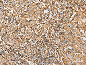 Immunohistochemistry of paraffin-embedded Human cervical cancer tissue using UBE2A Polyclonal Antibody at dilution of 1:55 (×200)