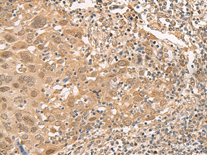 Immunohistochemistry of paraffin-embedded Human cervical cancer tissue using ISCU Polyclonal Antibody at dilution of 1:45 (×200)