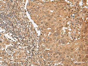 Immunohistochemistry of paraffin-embedded Human cervical cancer tissue using TIPRL Polyclonal Antibody at dilution of 1:65 (×200)