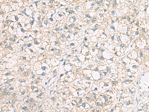 Immunohistochemistry of paraffin-embedded Human liver cancer tissue using POFUT1 Polyclonal Antibody at dilution of 1:50 (×200)