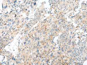 Immunohistochemistry of paraffin-embedded Human cervical cancer tissue using NXNL1 Polyclonal Antibody at dilution of 1:45 (×200)