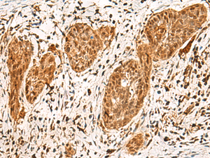 Immunohistochemistry of paraffin-embedded Human esophagus cancer tissue using POLR1E Polyclonal Antibody at dilution of 1:40 (×200)