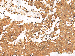 Immunohistochemistry of paraffin-embedded Human lung cancer tissue using SMOC1 Polyclonal Antibody at dilution of 1:35 (×200)