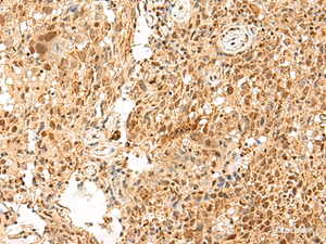 Immunohistochemistry of paraffin-embedded Human cervical cancer tissue using PAF1 Polyclonal Antibody at dilution of 1:55 (×200)