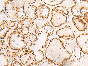 Immunohistochemistry of paraffin-embedded Human thyroid cancer tissue using POM121 Polyclonal Antibody at dilution of 1:40 (×200)