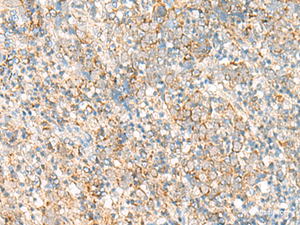 Immunohistochemistry of paraffin-embedded Human cervical cancer tissue using PSD4 Polyclonal Antibody at dilution of 1:50 (×200)