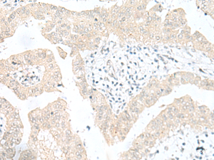 Immunohistochemistry of paraffin-embedded Human liver cancer tissue using SNRPD1 Polyclonal Antibody at dilution of 1:30 (×200)