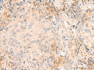 Immunohistochemistry of paraffin-embedded Human cervical cancer tissue using GSKIP Polyclonal Antibody at dilution of 1:45 (×200)