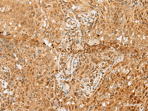 Immunohistochemistry of paraffin-embedded Human cervical cancer tissue using PNRC2 Polyclonal Antibody at dilution of 1:50 (×200)