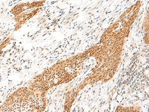 Immunohistochemistry of paraffin-embedded Human esophagus cancer tissue using RPS27A Polyclonal Antibody at dilution of 1:35 (×200)