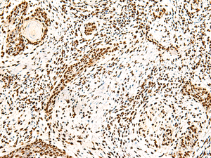 Immunohistochemistry of paraffin-embedded Human esophagus cancer tissue using ILF3 Polyclonal Antibody at dilution of 1:40 (×200)