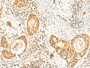 Immunohistochemistry of paraffin-embedded Human esophagus cancer tissue using ZNF580 Polyclonal Antibody at dilution of 1:75 (×200)